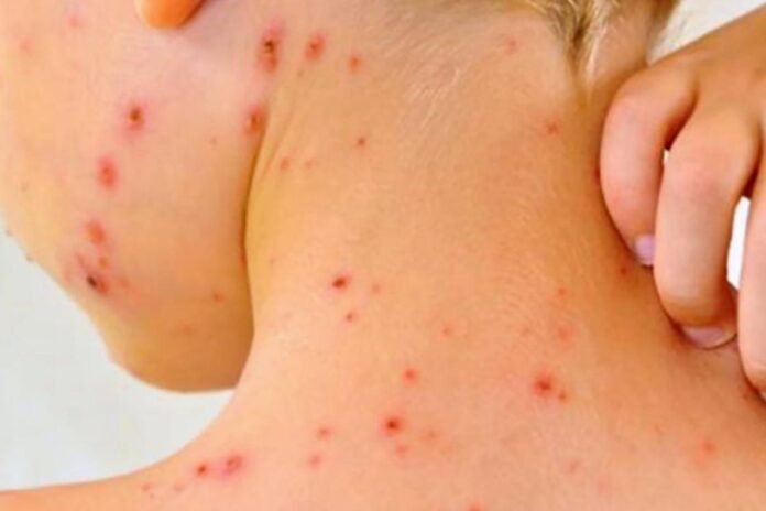 Sarampión en México: Suman 4 muertes, de los cuales tres no estaban vacunados y 1,629 casos confirmados