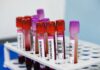 Secretaría de Salud de Quintana Roo desmiente casos de hantavirus en el estado y en México Muestras de sangre para prueba de Hantavirus en un laboratorio con resultado NEGATIVO