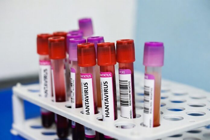 Muestras de sangre para prueba de Hantavirus en un laboratorio con resultado NEGATIVO